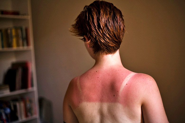 Sunburn normally takes eight to 10 hours to appear